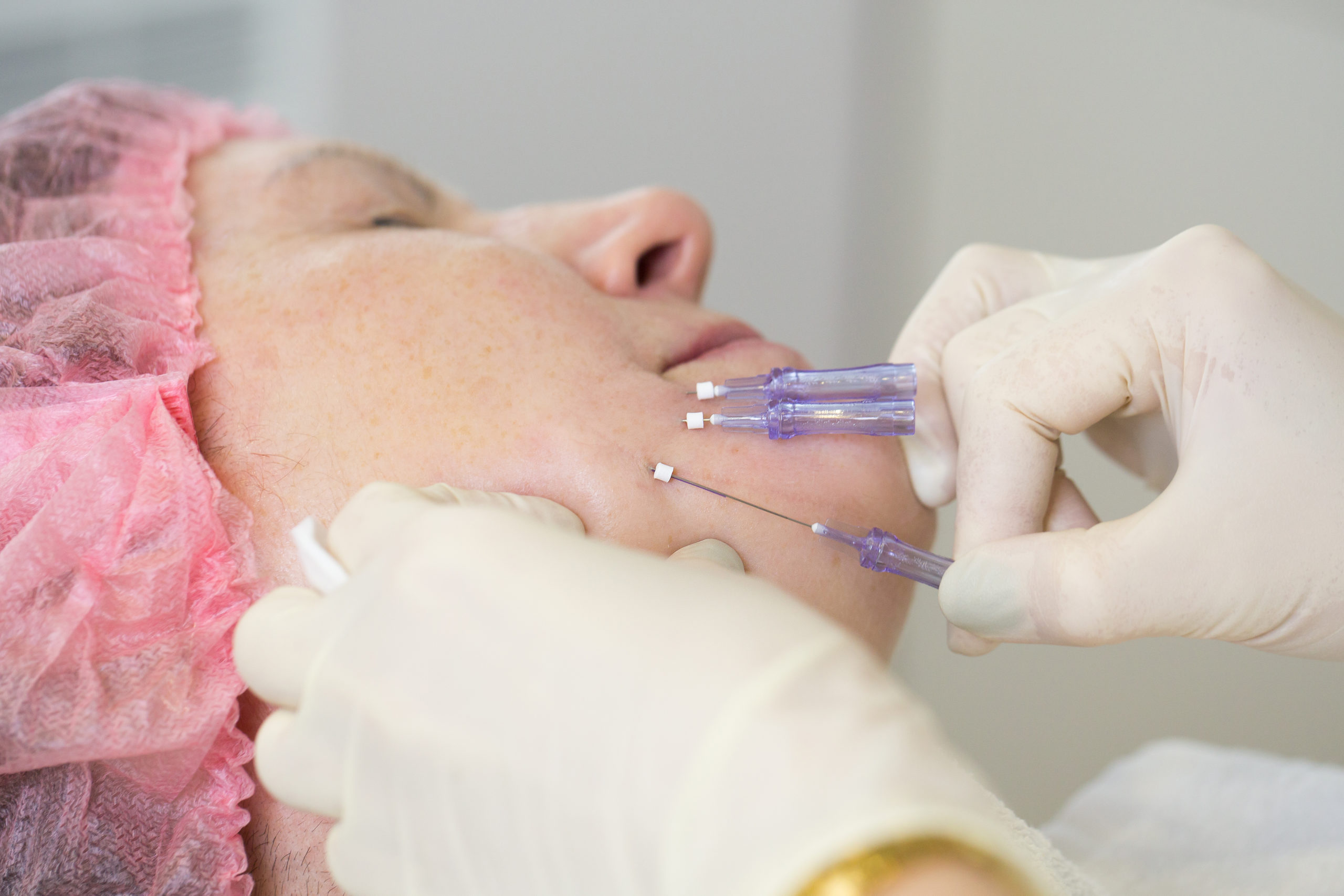 PDO Thread Lift Reversing Time with Non-Surgical Facial Rejuvenation